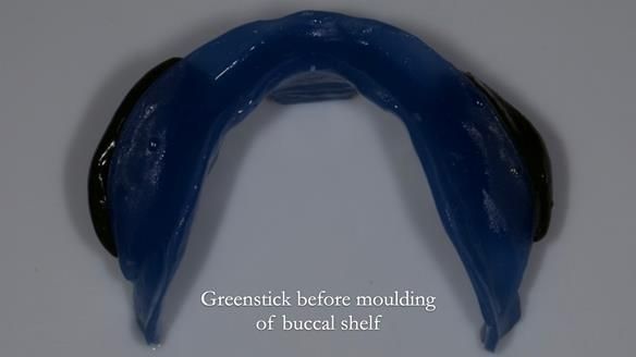 Newsletter 83: Sheila’s Complete Denture Success