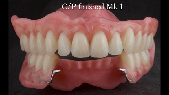 Newsletter 52 Managing Jo’s failing dentition with extractions and Mk 1/Mk 2 complete upper dentures and lower partial dentures FULL PROTOCOL