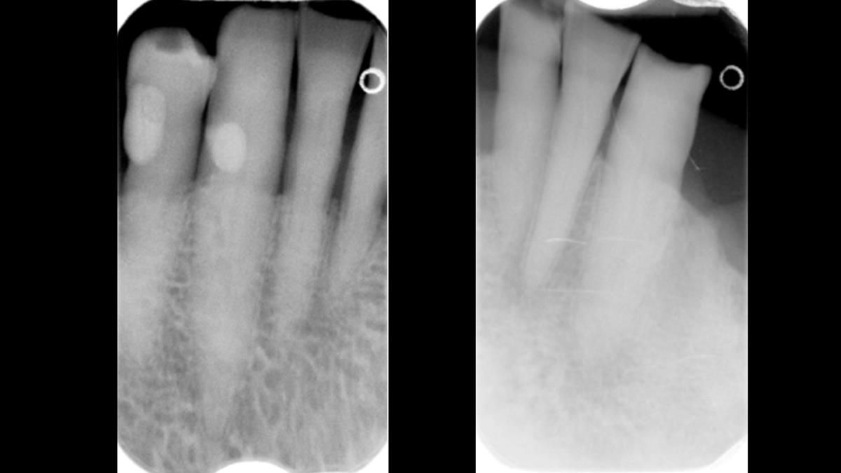 Newsletter 87 – Father Peter: A Partial Denture that needed Minor Miracle