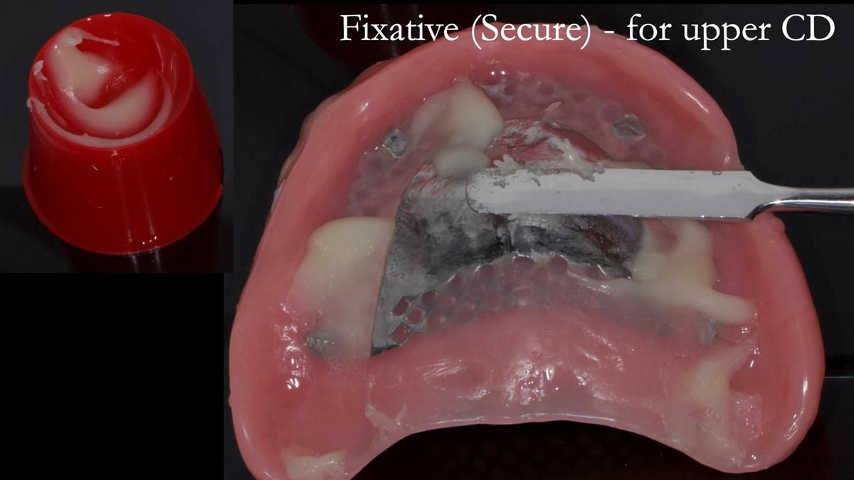 Newsletter 87 – Father Peter: A Partial Denture that needed Minor Miracle