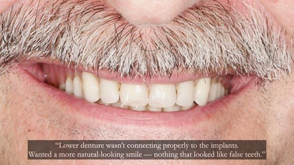 Newsletter 78: What do Clark Gable and a Locator® overdenture have in common?