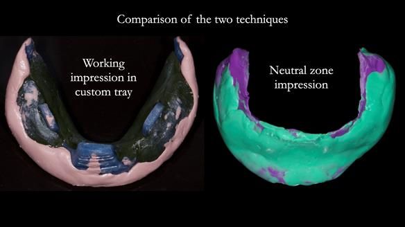 Newsletter 83: Sheila’s Complete Denture Success