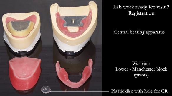 Replacing Madeline’s Complete denture FULL PROTOCOL