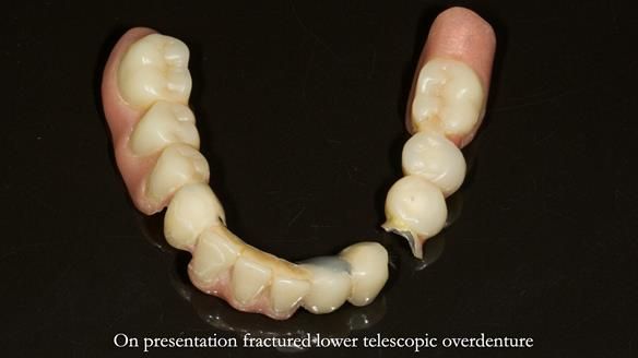 Newsletter 76: Jackie’s case – Telescopic overdenture & precision RPD (the tricky truth!)