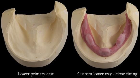 Replacing Madeline’s Complete denture FULL PROTOCOL