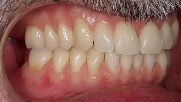 Newsletter 78: What do Clark Gable and a Locator® overdenture have in common?