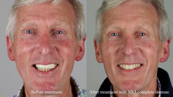 Newsletter 77: Jeremy’s case – immediate complete upper denture