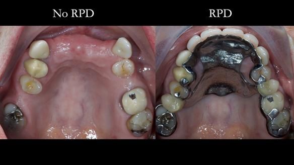 Newsletter 81 - Pam’s Story — how a partial denture changed her life (+ live walkthrough this Thursday)