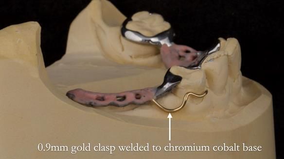 Eileen's transformation with upper and lower RPDs of Scandinavian hygienic design FULL PROTOCOL