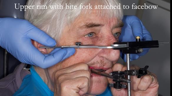 Newsletter 55 Provision of metal based partial dentures for Zephyrine with a repaired cleft lip and palate