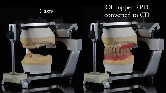 Finlay's Newsletter 62 provision of extractions and metal based complete dentures for Rafique