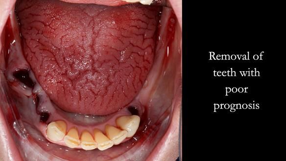 Newsletter 52 Managing Jo’s failing dentition with extractions and Mk 1/Mk 2 complete upper dentures and lower partial dentures FULL PROTOCOL