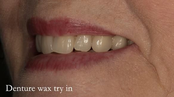 Newsletter 75: Marion’s case - Step-by-step complete denture workflow