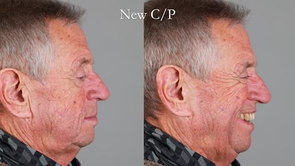 Newsletter 54 case presentation upper complete denture and lower Scandinavian designed hygienic partial denture for David