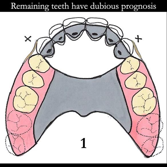 Universal Scandinavian partial denture designs