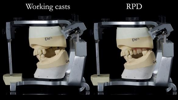 Newsletter 56 showing the making and fitting of a bilateral free end saddle upper removable partial denture (RPD) for patient with pemphigus