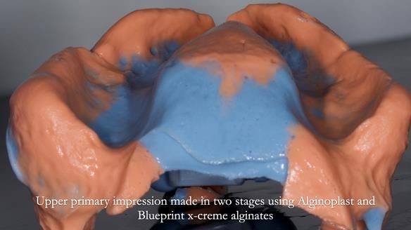 Newsletter 77: Jeremy’s case – immediate complete upper denture