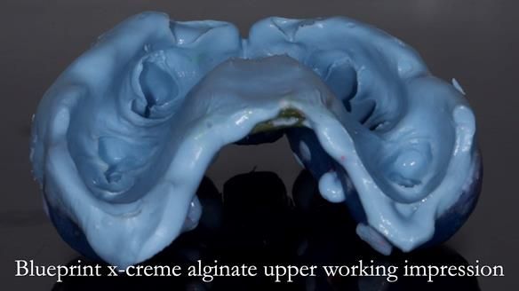 Newsletter 81 - Pam’s Story — how a partial denture changed her life (+ live walkthrough this Thursday)