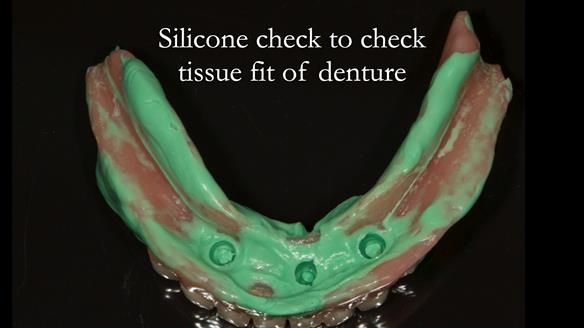 Prior to cold curing in the new attachments I wanted to make sure that the denture was seating properly on the saddles