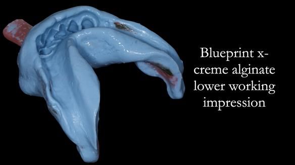 Newsletter 52 Managing Jo’s failing dentition with extractions and Mk 1/Mk 2 complete upper dentures and lower partial dentures FULL PROTOCOL