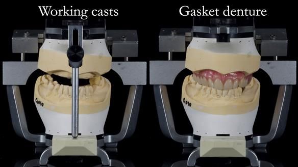 Finlay's Newsletter 58 Gasket upper partial denture for Zoe