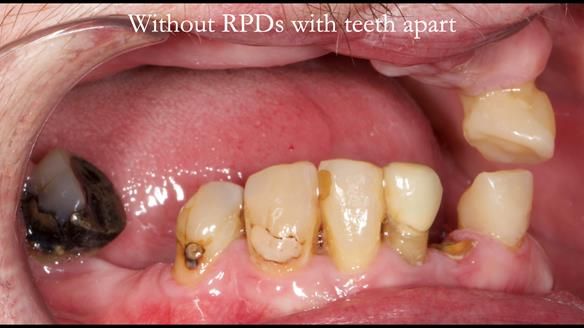 Newsletter 55 Provision of metal based partial dentures for Zephyrine with a repaired cleft lip and palate