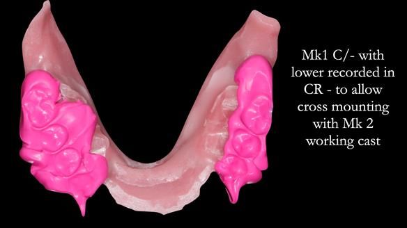 Newsletter 52 Managing Jo’s failing dentition with extractions and Mk 1/Mk 2 complete upper dentures and lower partial dentures FULL PROTOCOL