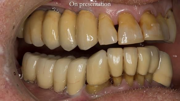 Ken – going downhill, first class