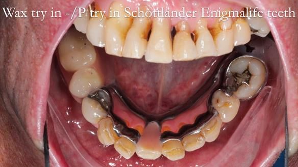Newsletter 54 case presentation upper complete denture and lower Scandinavian designed hygienic partial denture for David