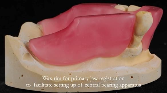 Finlay's Newsletter 59 Ultra hard partial dentures made for Gill