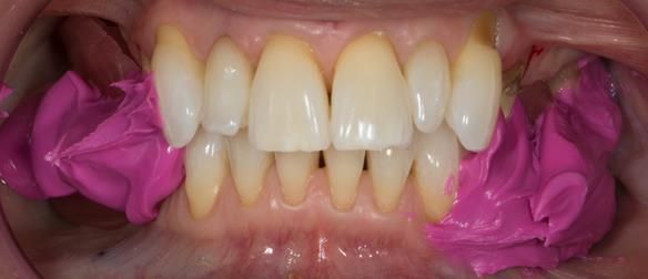 Figure 47 Futar D registration material - fixing together in ICP.