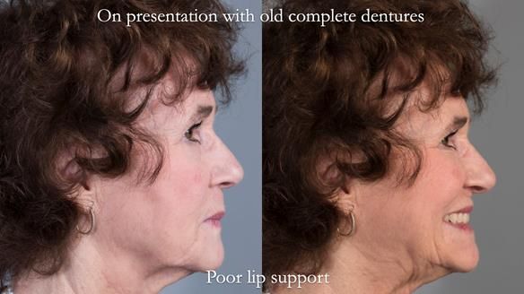 Newsletter 75: Marion’s case - Step-by-step complete denture workflow