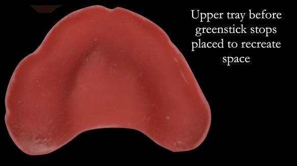 Newsletter 52 Managing Jo’s failing dentition with extractions and Mk 1/Mk 2 complete upper dentures and lower partial dentures FULL PROTOCOL