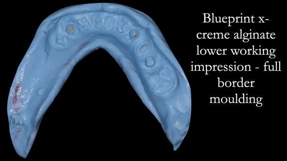Newsletter 44 - extreme removable prosthodontics – engineering a super-strong and ultra-thin over denture