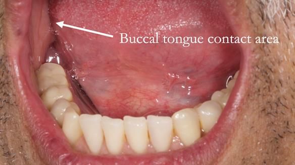 Finlay's Newsletter 62 provision of extractions and metal based complete dentures for Rafique