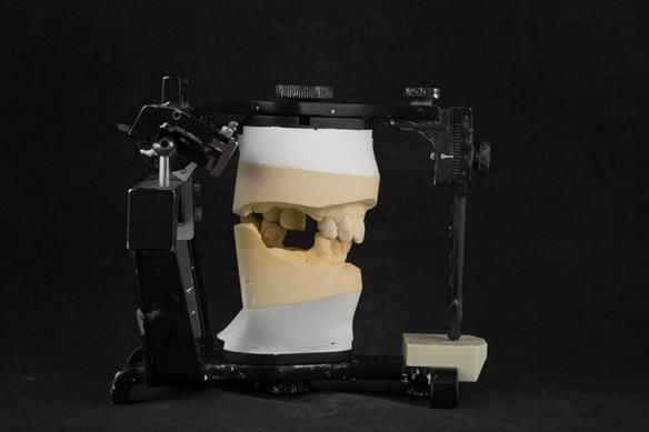 Figure 20 Mounted working cast with teeth/pontics removed in ICP for Mk 1 dentures