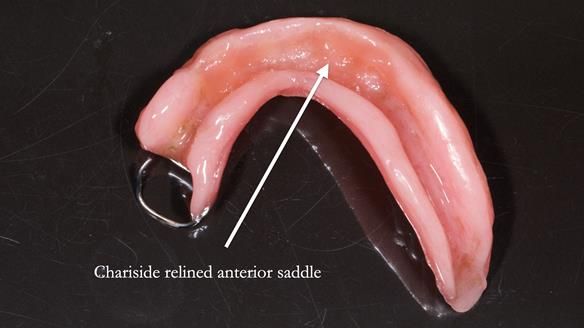 Newsletter 82 Mary - A complete upper and a one-tooth gasket denture