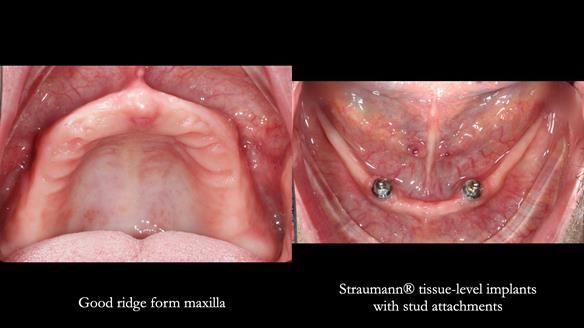 Newsletter 78: What do Clark Gable and a Locator® overdenture have in common?