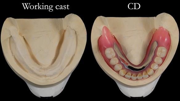 Finlay's Newsletter 62 provision of extractions and metal based complete dentures for Rafique