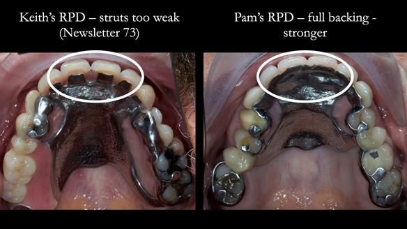 Newsletter 81 - Pam’s Story — how a partial denture changed her life (+ live walkthrough this Thursday)