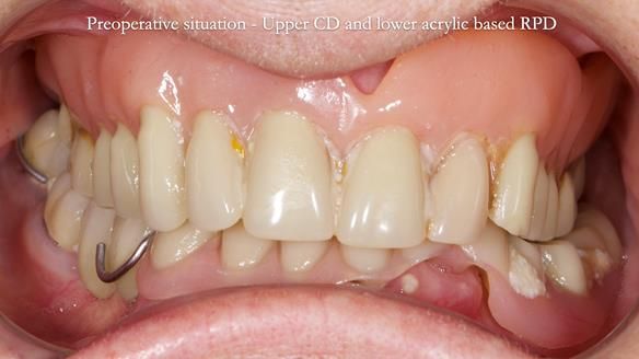 Newsletter 82 Mary - A complete upper and a one-tooth gasket denture