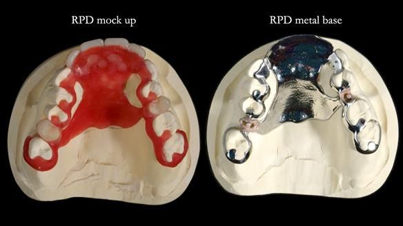 Newsletter 81 - Pam’s Story — how a partial denture changed her life (+ live walkthrough this Thursday)