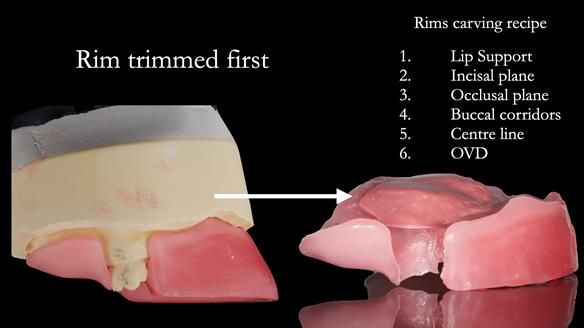 Newsletter 52 Managing Jo’s failing dentition with extractions and Mk 1/Mk 2 complete upper dentures and lower partial dentures FULL PROTOCOL