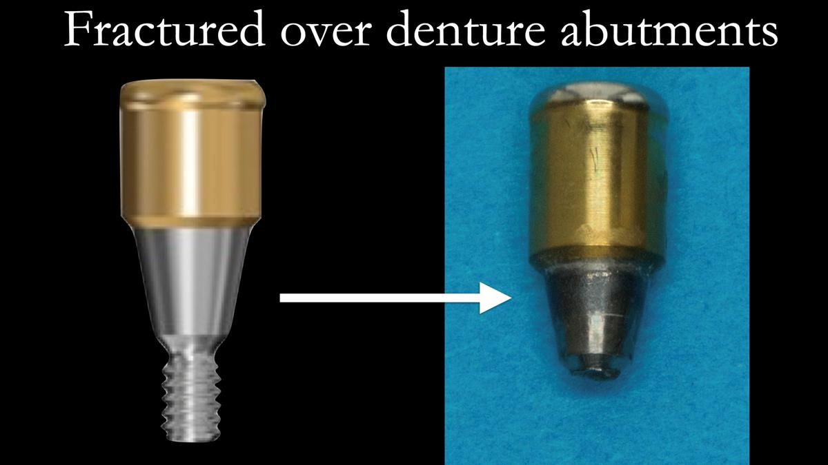 Newsletter 87 – Father Peter: A Partial Denture that needed Minor Miracle