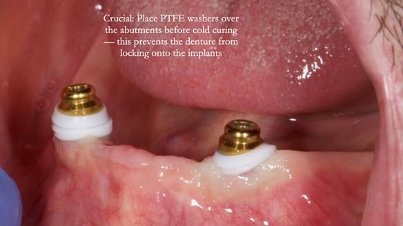 Newsletter 78: What do Clark Gable and a Locator® overdenture have in common?