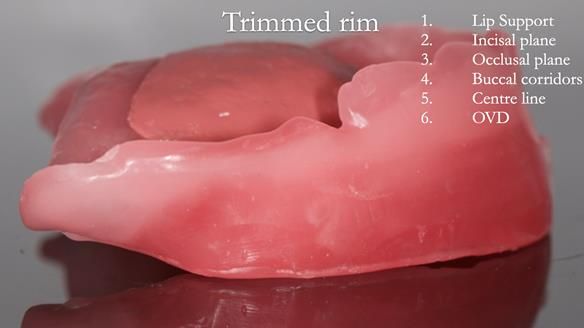 Newsletter 54 case presentation upper complete denture and lower Scandinavian designed hygienic partial denture for David