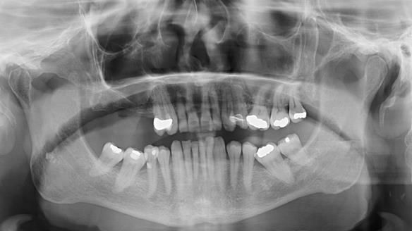 Finlay's Newsletter 64 case study - provision of a Kennedy class 2 metal based Scandinavian RPD for Ian