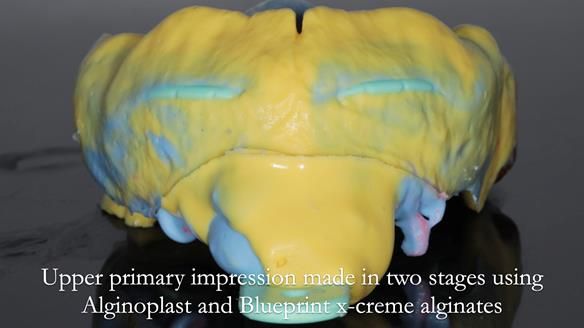 Finlay's Newsletter 60 Sylvia's upper Kennedy Class 2 Mod 1 metal based upper RPD