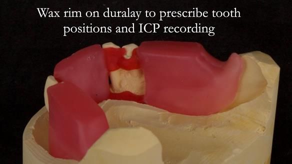 Finlay's Case Study Newsletter 40 - Immediate Mk 1 RPD to Definitive Mk 2 RPD - full protocol