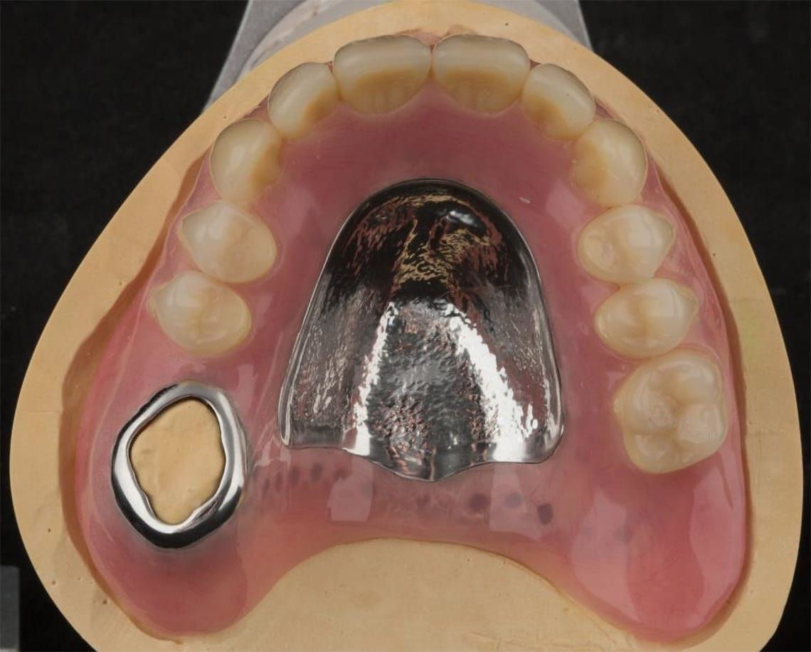 The "window denture" - provision of a maxillary cobalt chromium based partial denture